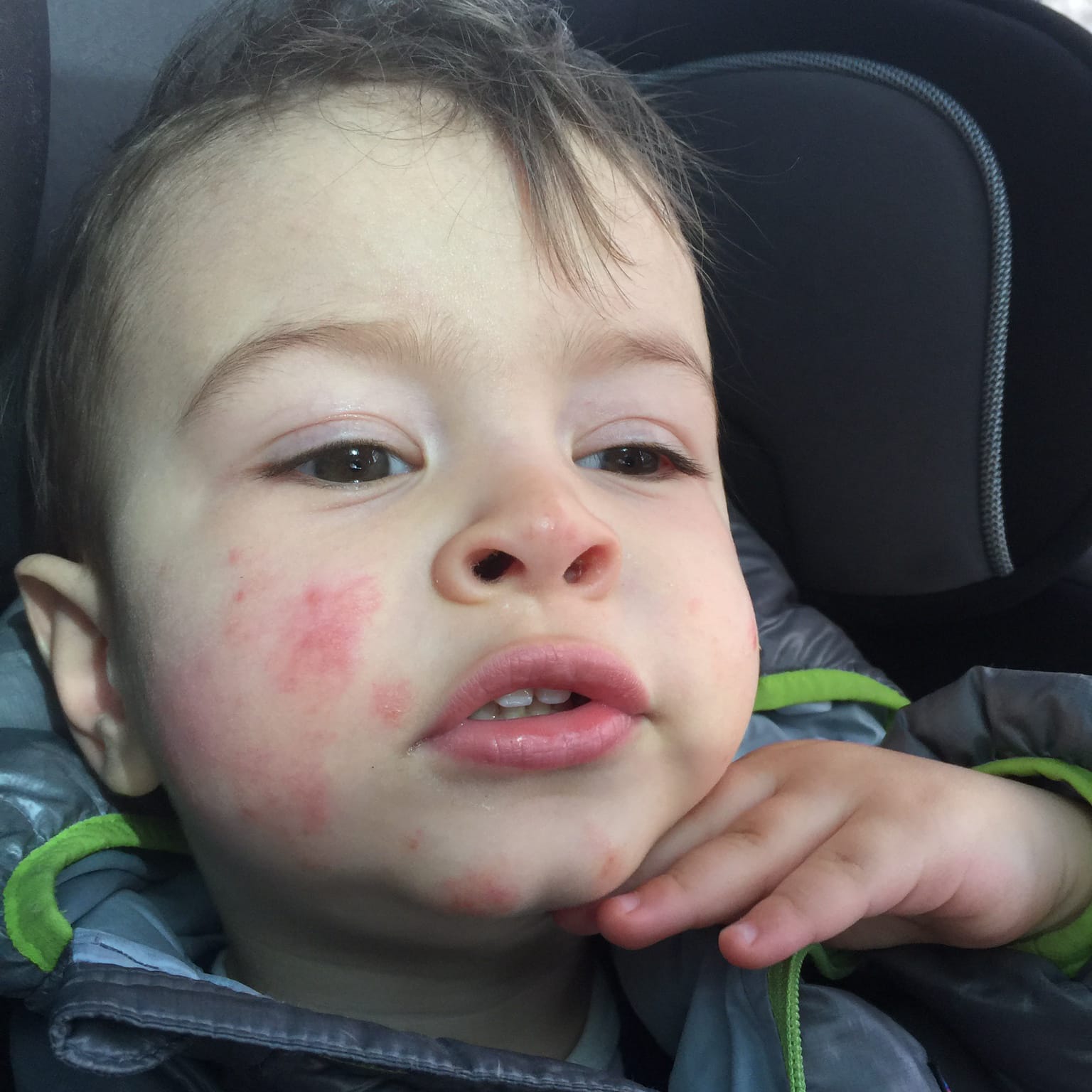Four Tips from an Eczema Mom