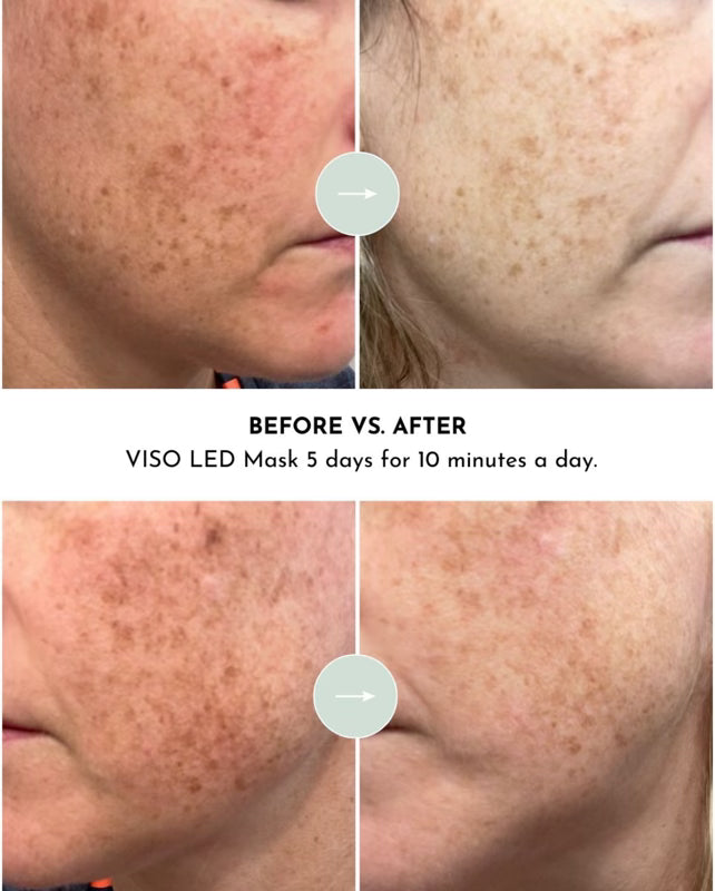 VISO FDA-Certified Red Light Therapy Mask - 470 Micro-LEDs for Anti-Aging