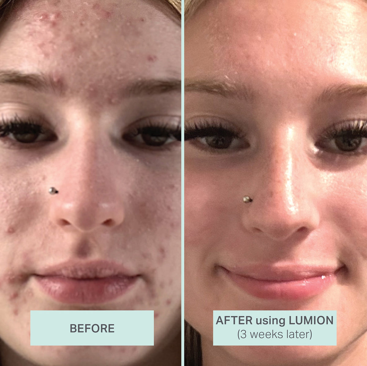 Lumion Save My Skin Serum