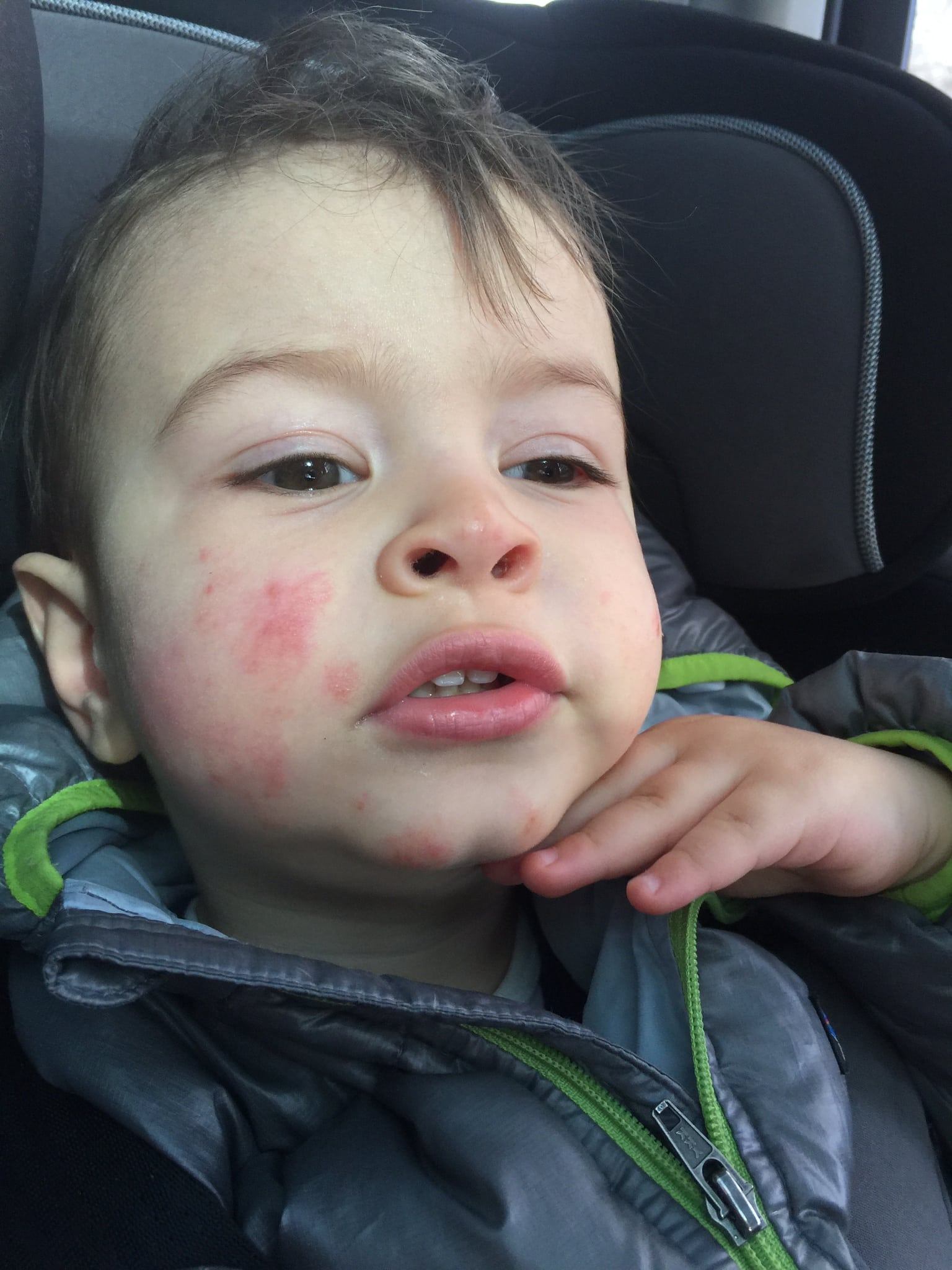 Four Tips from an Eczema Mom